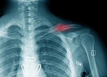 £15,000 Compensation for Substandard Collarbone Surgery