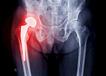 £55,000 for Six Years of Pain After Negligent Hip Replacement