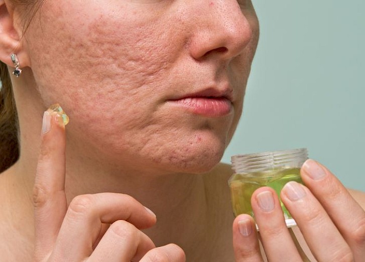 The Legal Blemish of Acne Scar Treatment